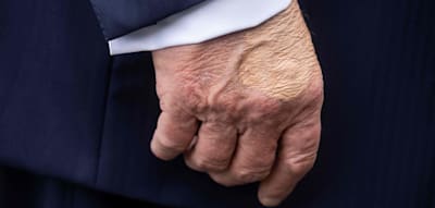 Seltsamer Fleck an Trumps Hand sorgt für Spekulationen – Weißes Haus gibt Erklärung ab